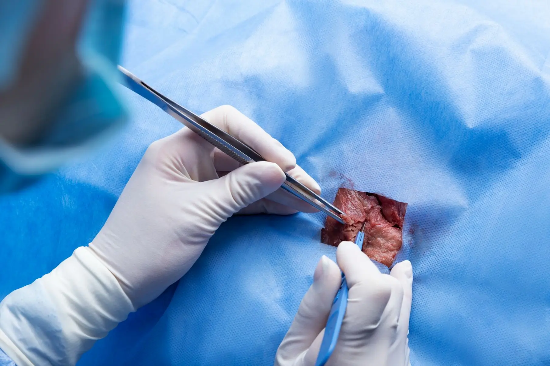 Liver Transplant Lucknow